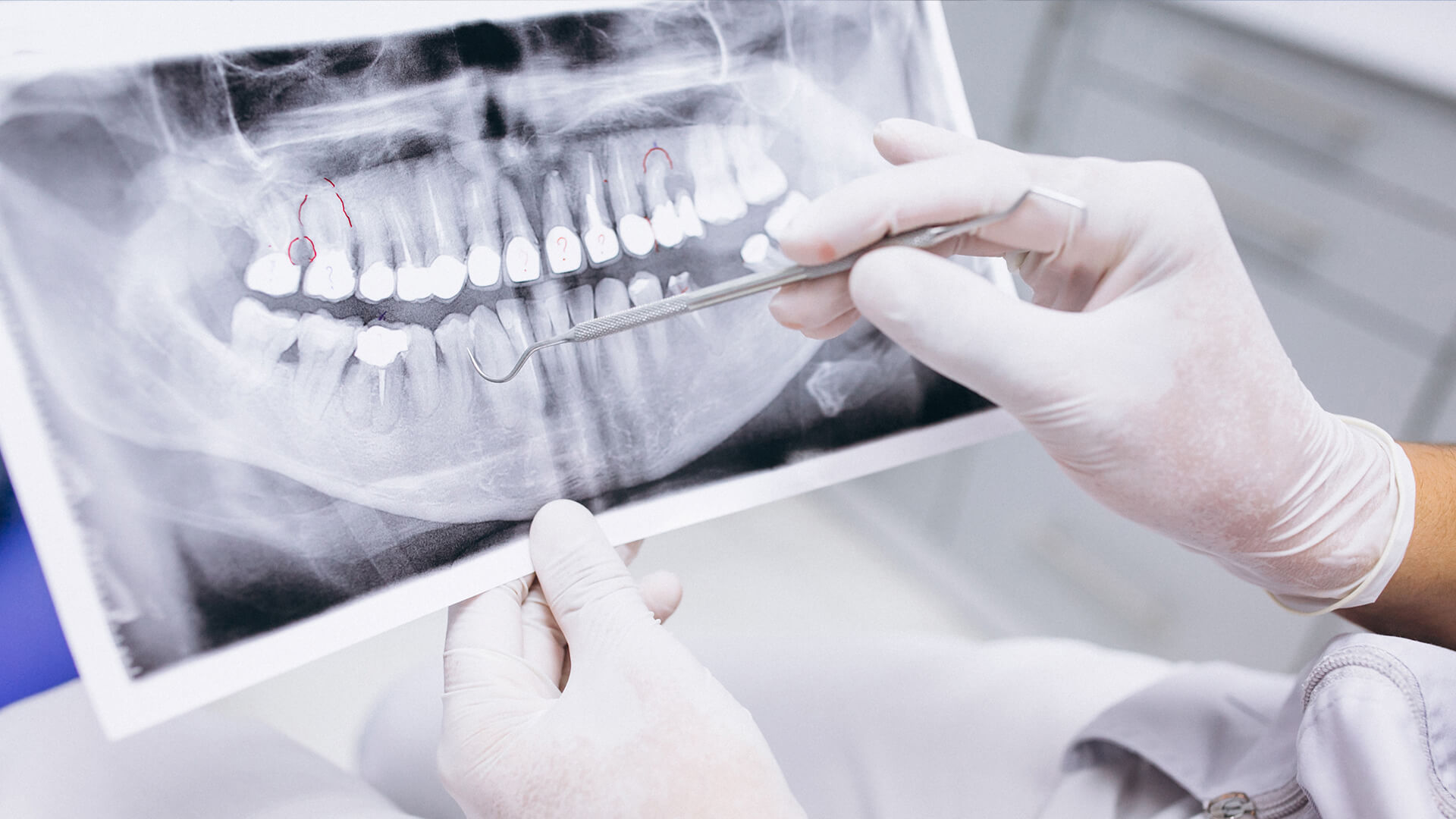 Root Canal Therapy - Watkinsville Georgia